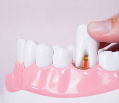 עקירות כירורגיות בשיניים